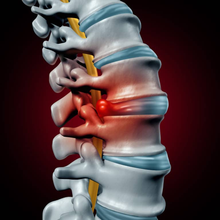 Bulging Disk vs. Herniated Disc: What’s the Difference